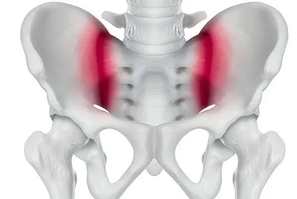 SI Joint Arthropathy And Sacroiliitis Treatment