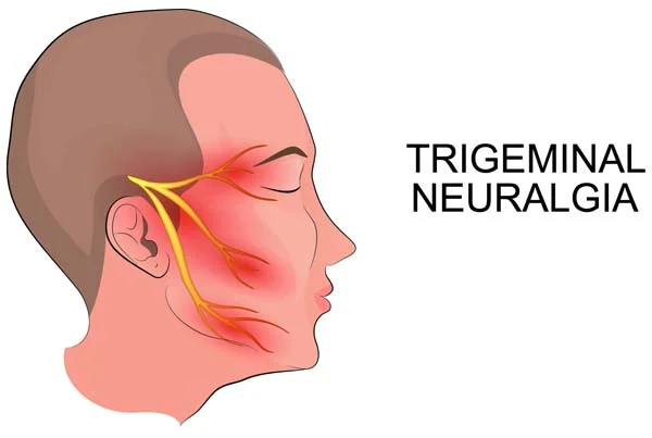 Trigeminal Neuralgia Treatment
