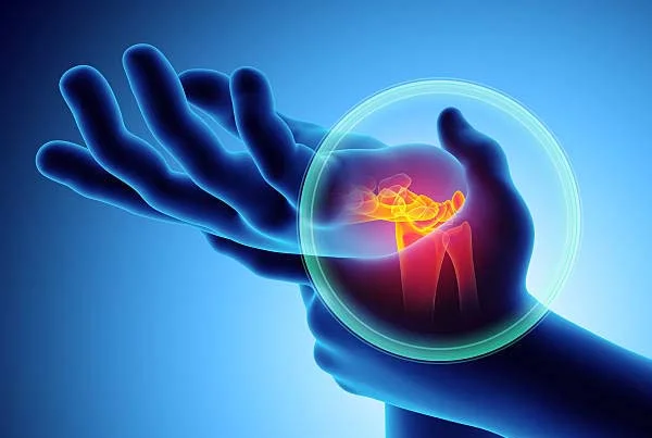 Carpal Tunnel Syndrome Treatment