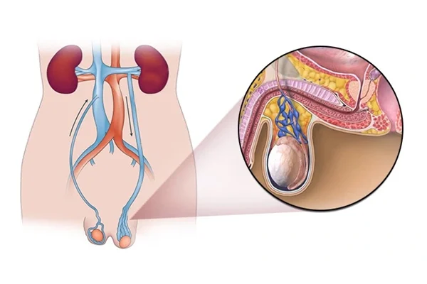Varicocele Embolization Treatment