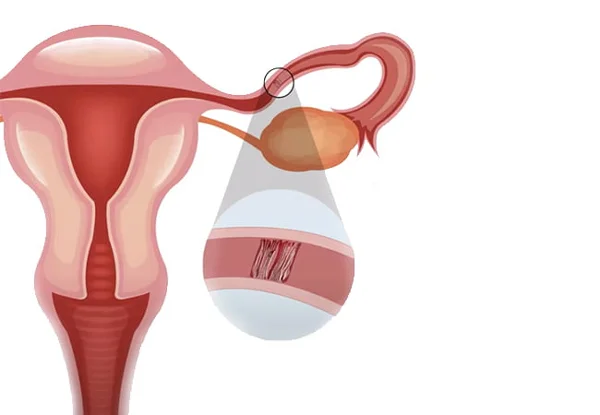 Fallopian Tube Recanalisation Treatment