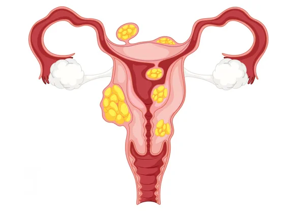 Fibroid Treatment