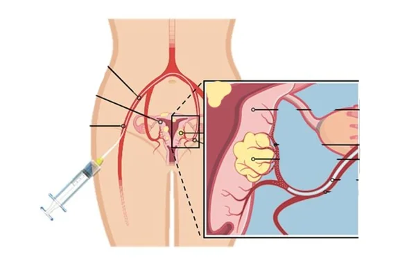 Uterine Artery Embolisation (UAE) And Ablation