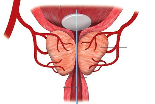 Prostatic Artery Embolization (PAE) Treatment