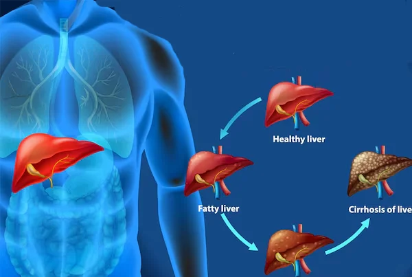Liver Cirrhosis And PHT
